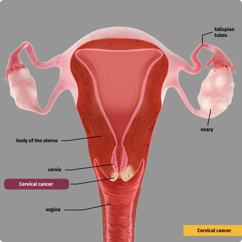 Cervical cancer. Malignant cells invade the surrounding tissue (invasive carcinoma).