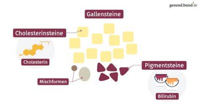 How do gallstones develop?