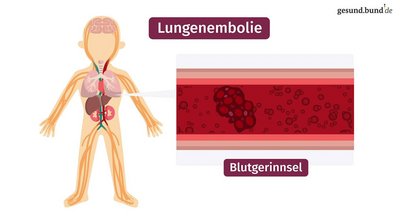 What is pulmonary embolism?