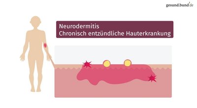 What is neurodermatitis and what treatment is available?