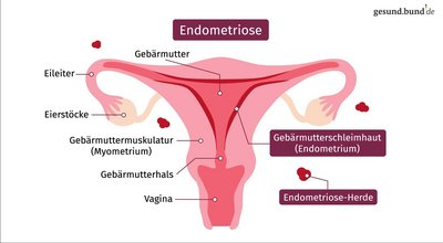 What causes endometriosis?