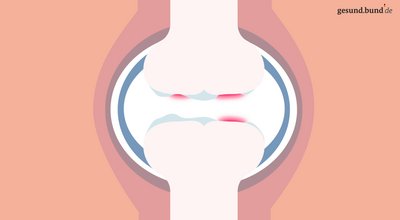 What causes osteoarthritis?