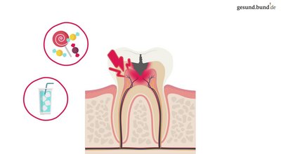 What causes caries?