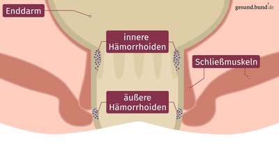 What are hemorrhoids?