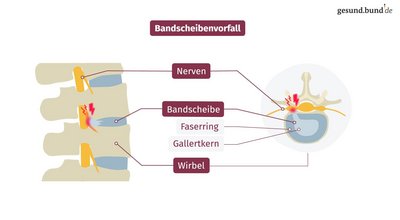 What is a slipped disc?