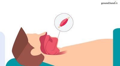 What is obstructive sleep apnea?