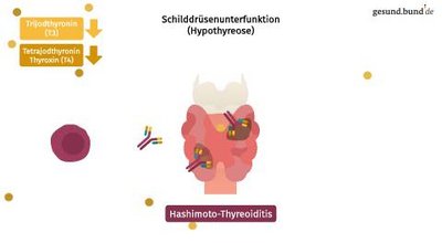What are the common forms of thyroid disease?