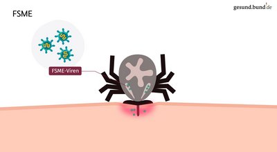What are the signs of TBE?