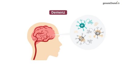 What is dementia?