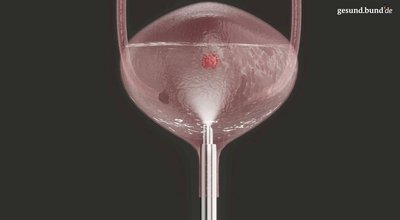 How is a bladder tumor removed?