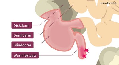 What happens during appendicitis?