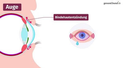 What is conjunctivitis?