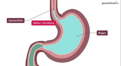 What is reflux?