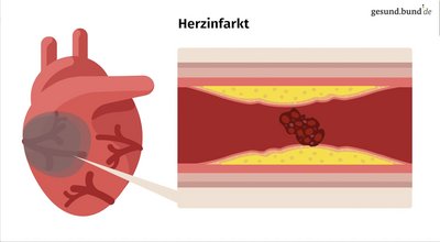 What happens during a heart attack?
