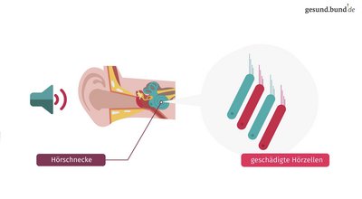 What is tinnitus?