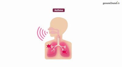 What is asthma?