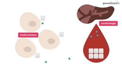 What is type 2 diabetes?