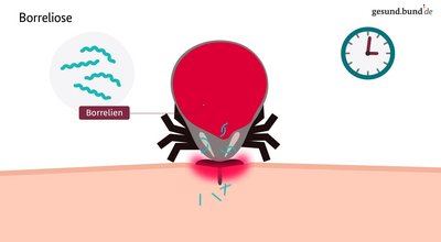 What are the signs of Lyme disease (borreliosis)?