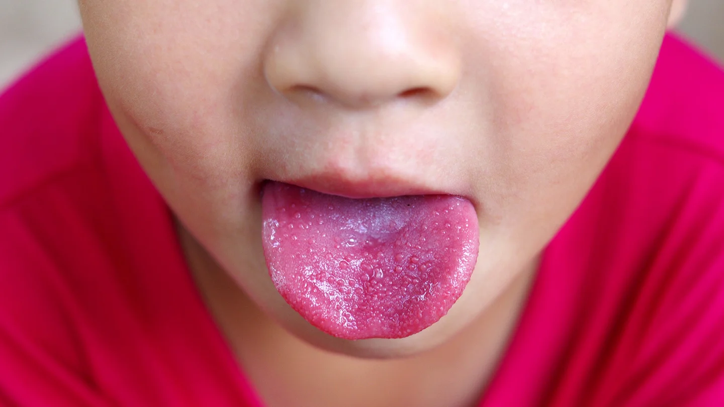 Das Bild zeigt ein Kind mit einer für Scharlach typischen, geröteten Zunge.
