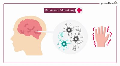 What is Parkinson’s disease?