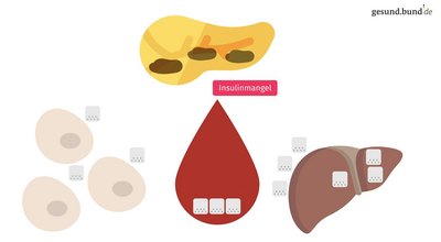 What is type 1 diabetes?