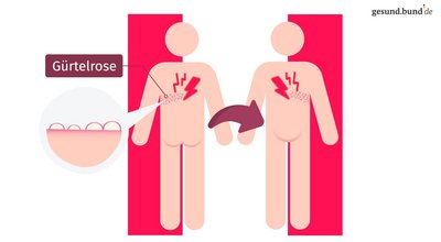 What causes shingles?