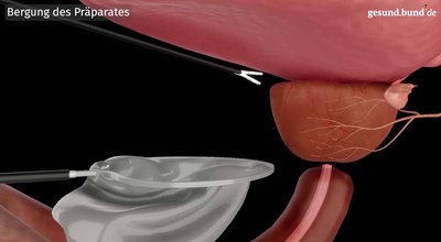 What is a laparoscopic prostatectomy?