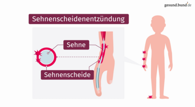 Darstellung einer Sehnenscheidenentzündung im Bereich des Handgelenks.