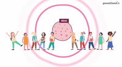 What causes acne?