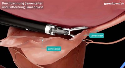 What is a robotic prostatectomy?