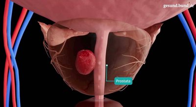 What is an open prostatectomy?