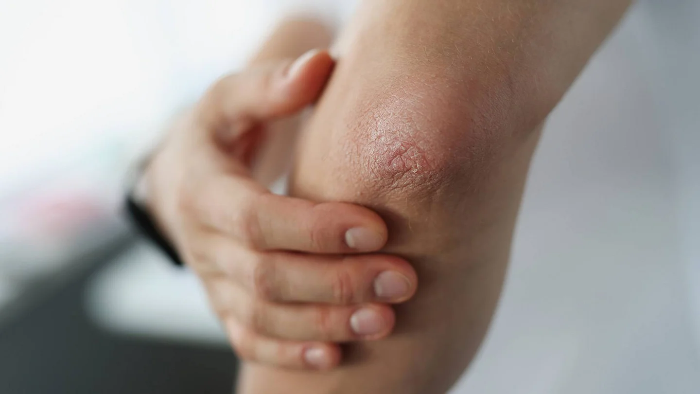 Ellbogen mit trockener, rissiger Haut