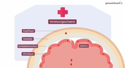 What is a traumatic brain injury?