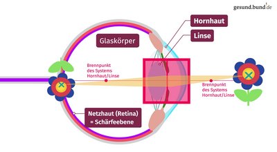 What is a vision condition?